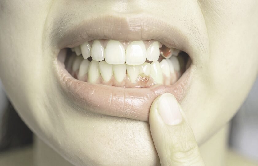 歯周病で歯茎から出血