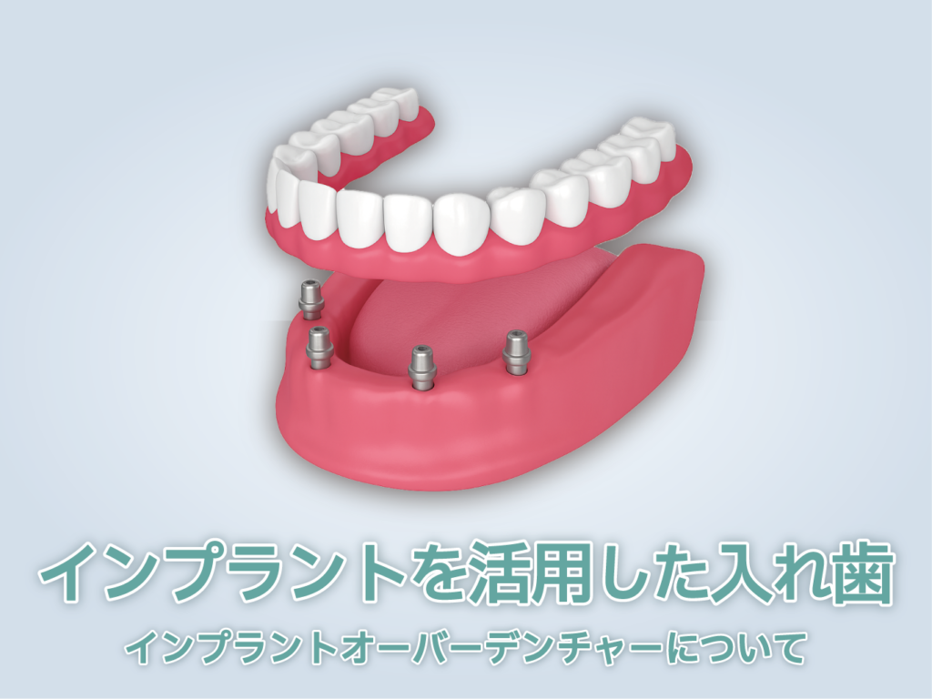 インプラントオーバーデンチャー